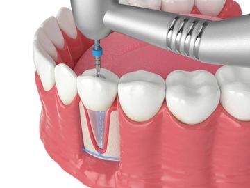 Behandlung der entzündlichen internen Wurzelresorption im rechten oberen Eckzahn mit biokeramischem Zement: Ein Fallbericht.