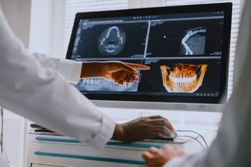 Mandibular Repositioning Appliances: Evidence-Based OSA Guide