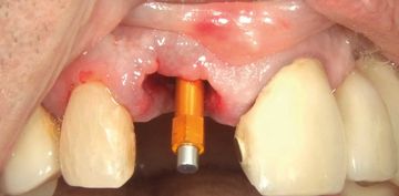 "The Perfect Screw" in Older Patients (Part 3)