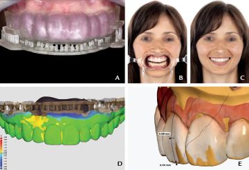Fabrication of a CAD/CAM combination matrix for trial restorations: A dental technique