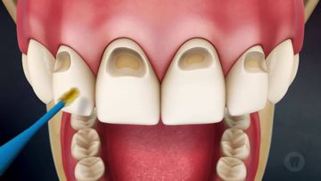 Erosione dentale. Cause, clinica, diagnosi