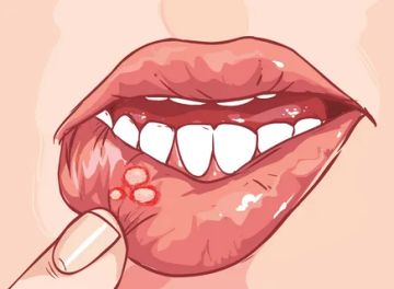 Primary and secondary elements of lesions of the oral mucosa