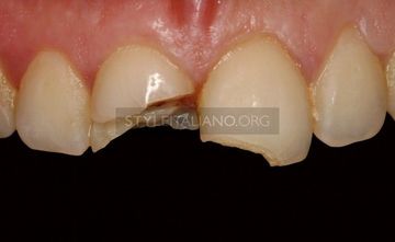 Restoration of extensive crown fracture
