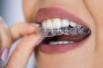 The Benefits of Optimized Attachments in Clear Aligner Orthodontics