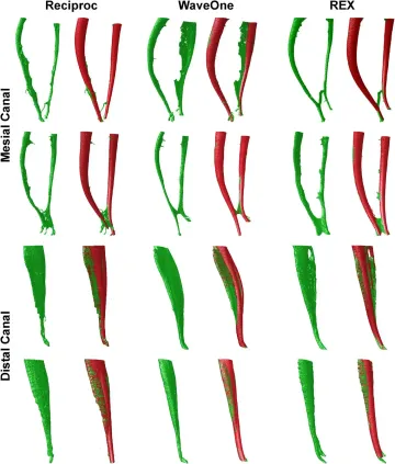 Design, Metallurgy, Mechanical Properties , and Shaping Ability of 3 Heat‑Treated Reciprocating Systems: A Multimethod Investigation