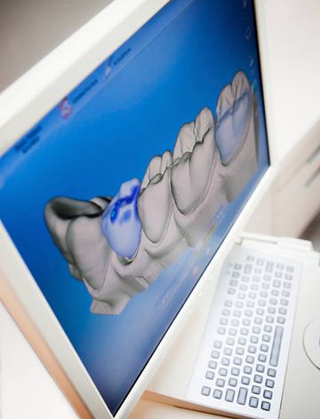 Avaliação por Micro-CT das calcificações do polpa radicular em dentes molares superiores extraídos