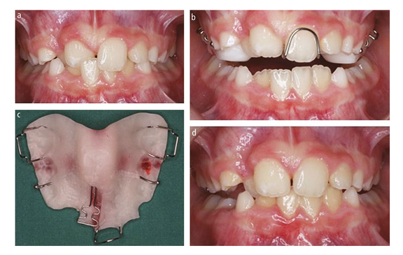 Early Orthodontic Treatment for Class III Malocclusions