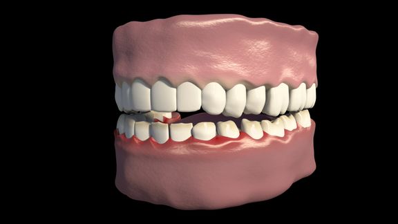 Pathological Tooth Clinic of Pathological Tooth Wear