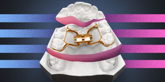 OrthoEvolution 3.0: Ретенция результата ортодонтического лечения с ...