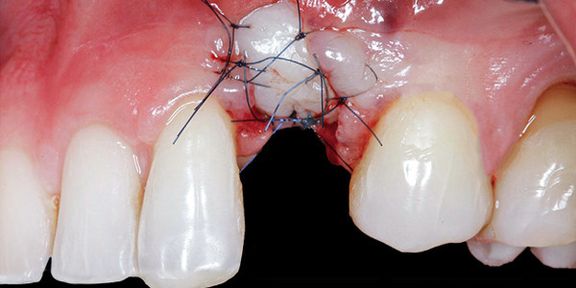 Post extraction cases: the State of Art (part 1)