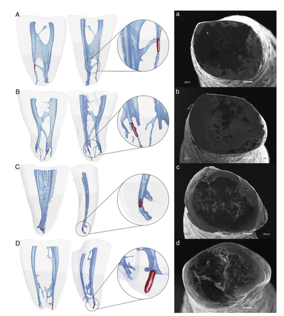Study on R-Pilot Pathfinding Instrument in Mandibular Molars
