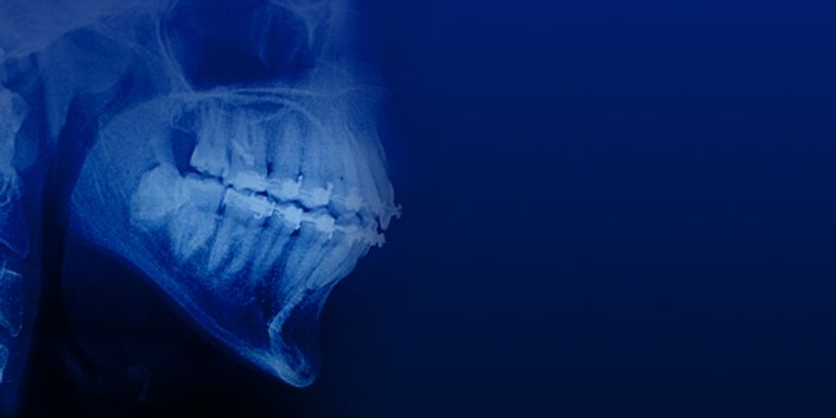 Orthodontic extrusion for the restoration of the structurally ...
