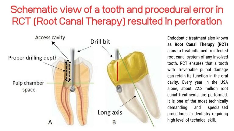 Webinar by OVIdental Go: Endodontic Tooth Anatomy and RCT Perforation ...