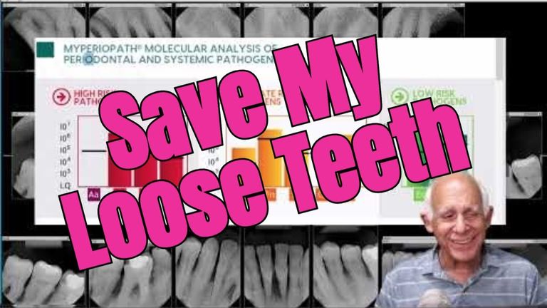Webinar by Lee Sheldon: 3 Secrets to Save Loose Teeth | OHI-S