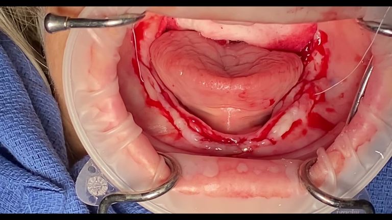 Webinar by Jonathan Bullard: The Texas Two-Step Suture | OHI-S