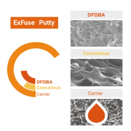 ExFuse DBM Putty with Cancellous Bone, 1cc Putty in Syringe. Anatomic based