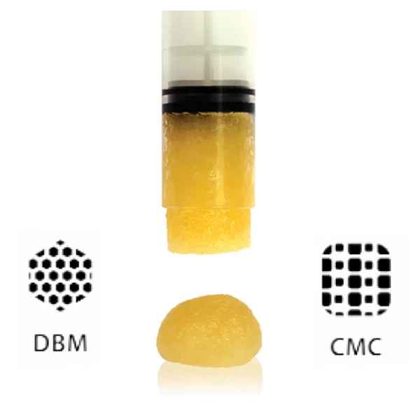 C-Graft Putty Demineralized Bone Matrix 0.5cc Syringe. Ready to use.