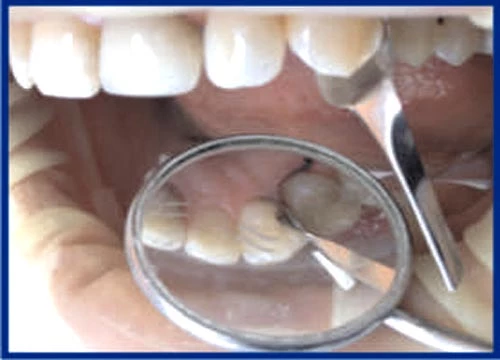 Proximal Anterior Strips 1.387 (12 pcs.)