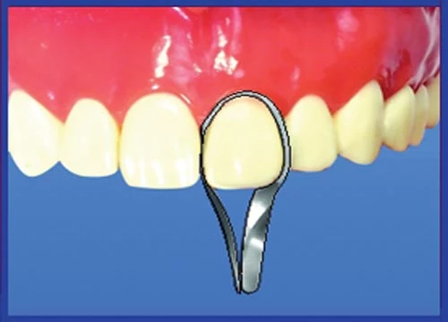 Twin Anterior Matrices 1.523 (12 pcs.)
