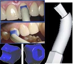 Veneer Styx Starter Kit - 1 Autoclavable Handle and 6 Disposable Tips. A Must