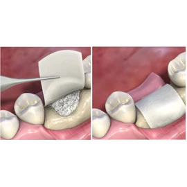 Membrana dental de colágeno regenerativo MatrixDerm 15mm x 20mm, 1/caja. Tiene