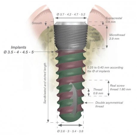 Implante Anatómico Natural ETK 4.0 x 10 mm, el implante natural está hecho de grado IV.