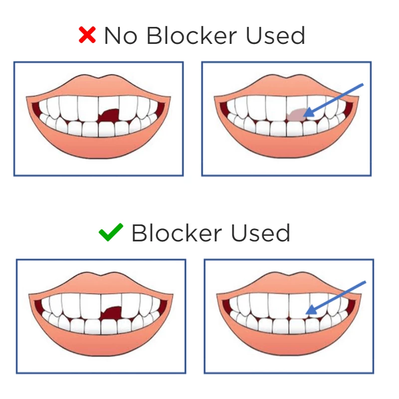 Omnichroma Blocker композит - шприц 4 г.